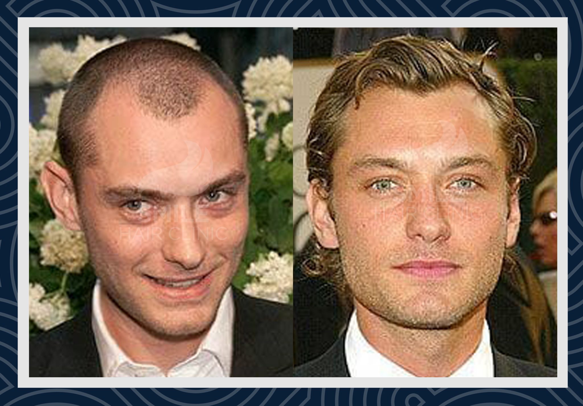 Haartransplantation Jude Law Smile Hair