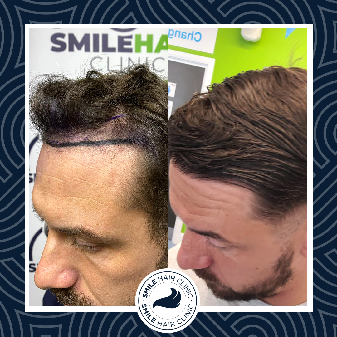 Hair Transplant Turkey Before After - Smile Hair Clinic