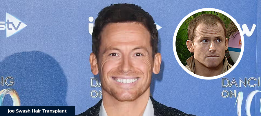 Joe Swash Hair Transplant Smile Hair Clinic